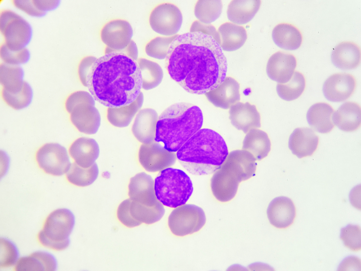 Mantle-Cell-Lymphoma