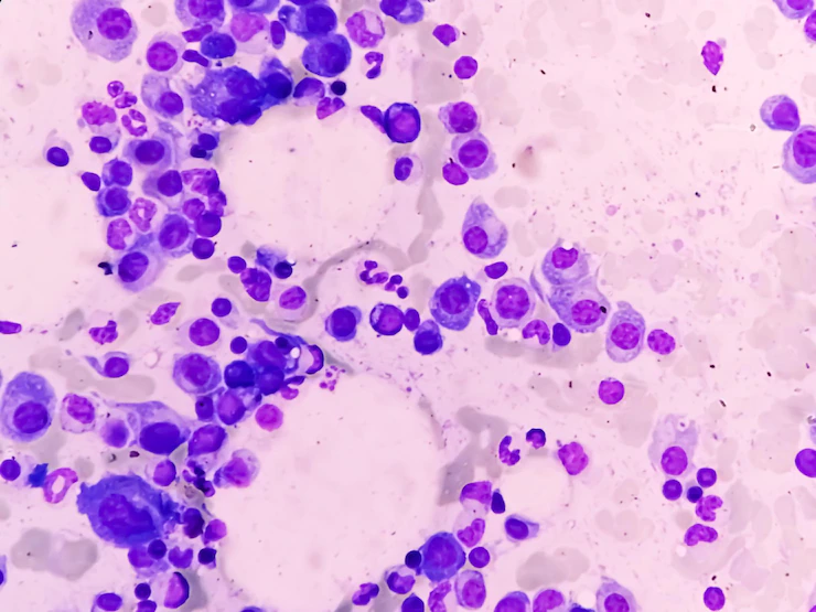 Multiple Myeloma