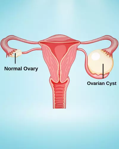 Ovarian Cyst vs Ovarian Cancer​