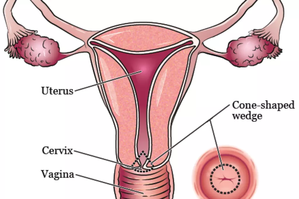 cervical-cancer