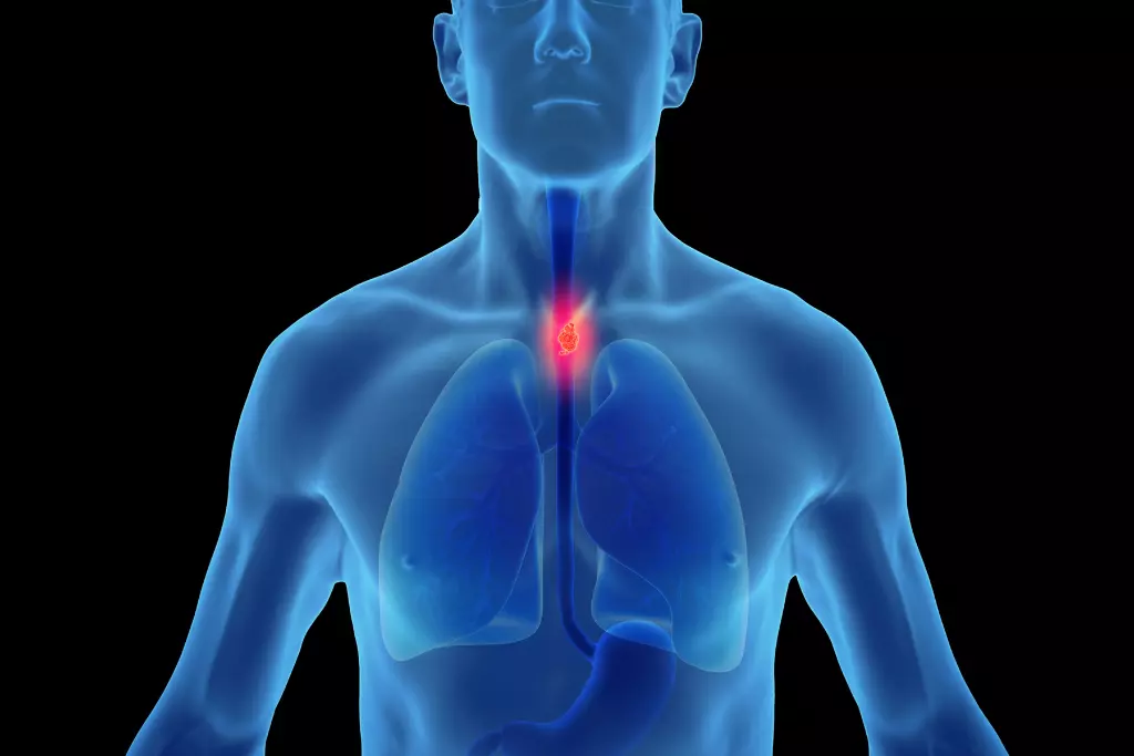 esophageal-cancer