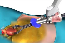 Robotic Radical Prostatectomy​