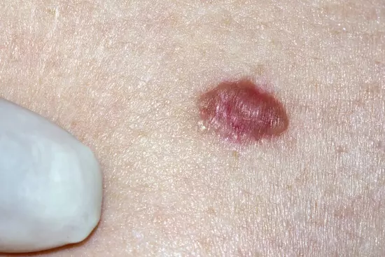 basal-cell-carcinoma-of-skin