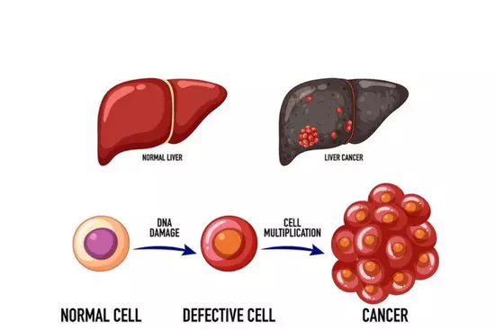 liver-cancer